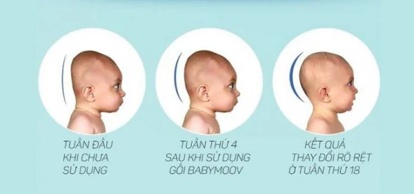 REVIEW gối chống bẹp đầu Babymoov thông tin vô cùng bổ ích cho các mẹ